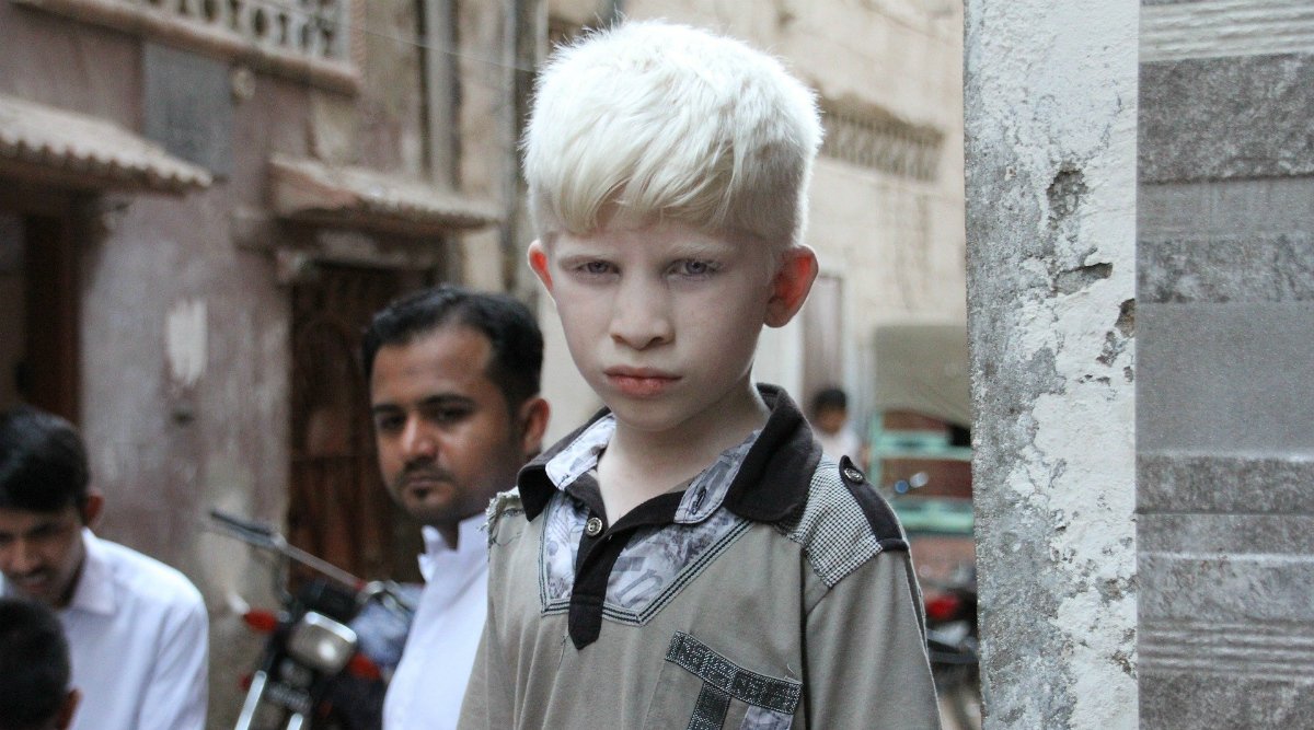 International Albinism Awareness Day 2020 Date & Theme: Know the History and Significance of the Day to Celebrate the Human Rights of Persons With Albinism