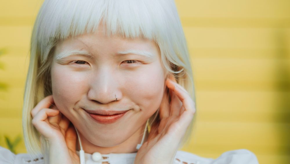 International Albinism Awareness Day 2020: What Causes Albinism? Types of This Genetic Disorder Causing Skin and Hair Discolouration Explained!