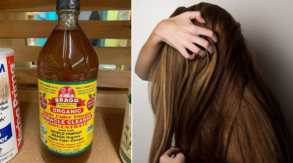 Home Remedy of the Week: How Apple Cider Vinegar Can Help Treat Dandruff And Itchy Scalp (Watch Video)