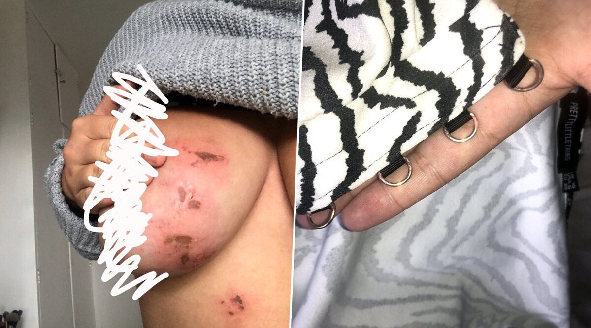 Woman Receives 'Burns on Her Boobs' After Wearing £15 PrettyLittleThing Top Once! Graphic Images Infuriate Netizens