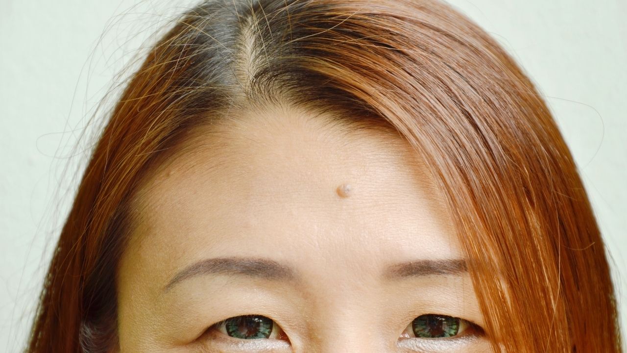 Mole on Forehead