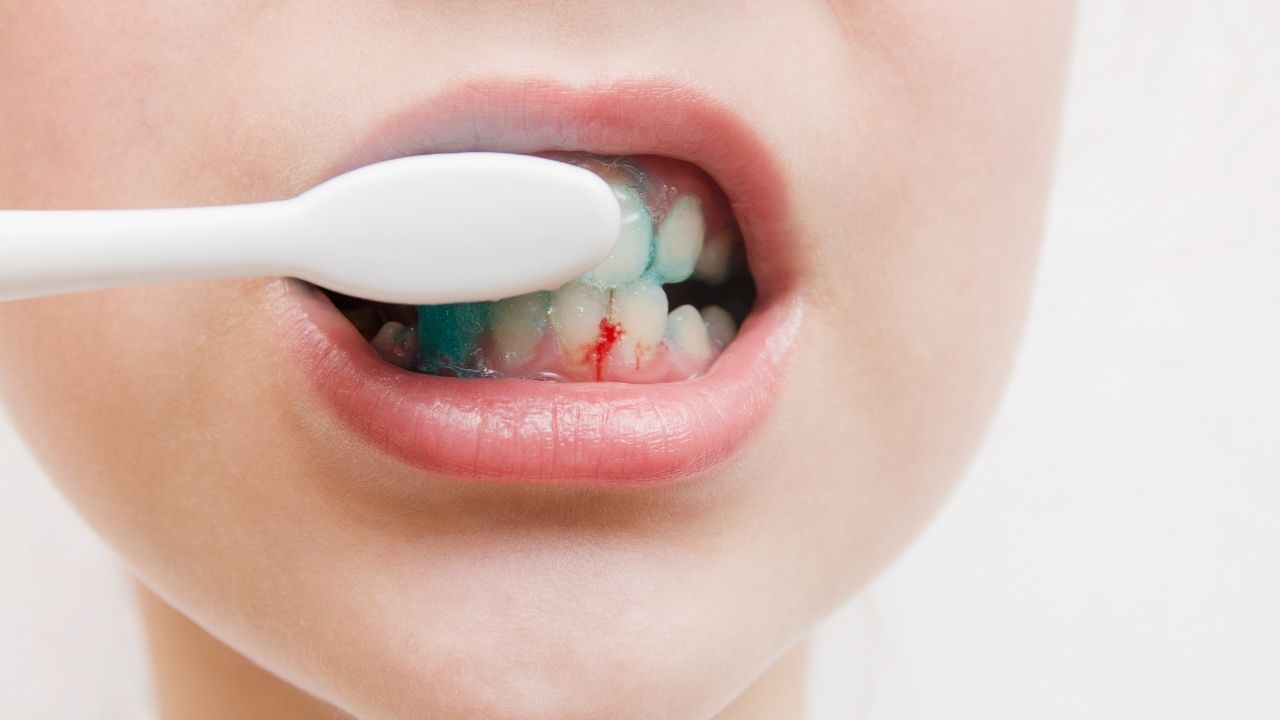 10 effective ways to stop bleeding from gums or teeth