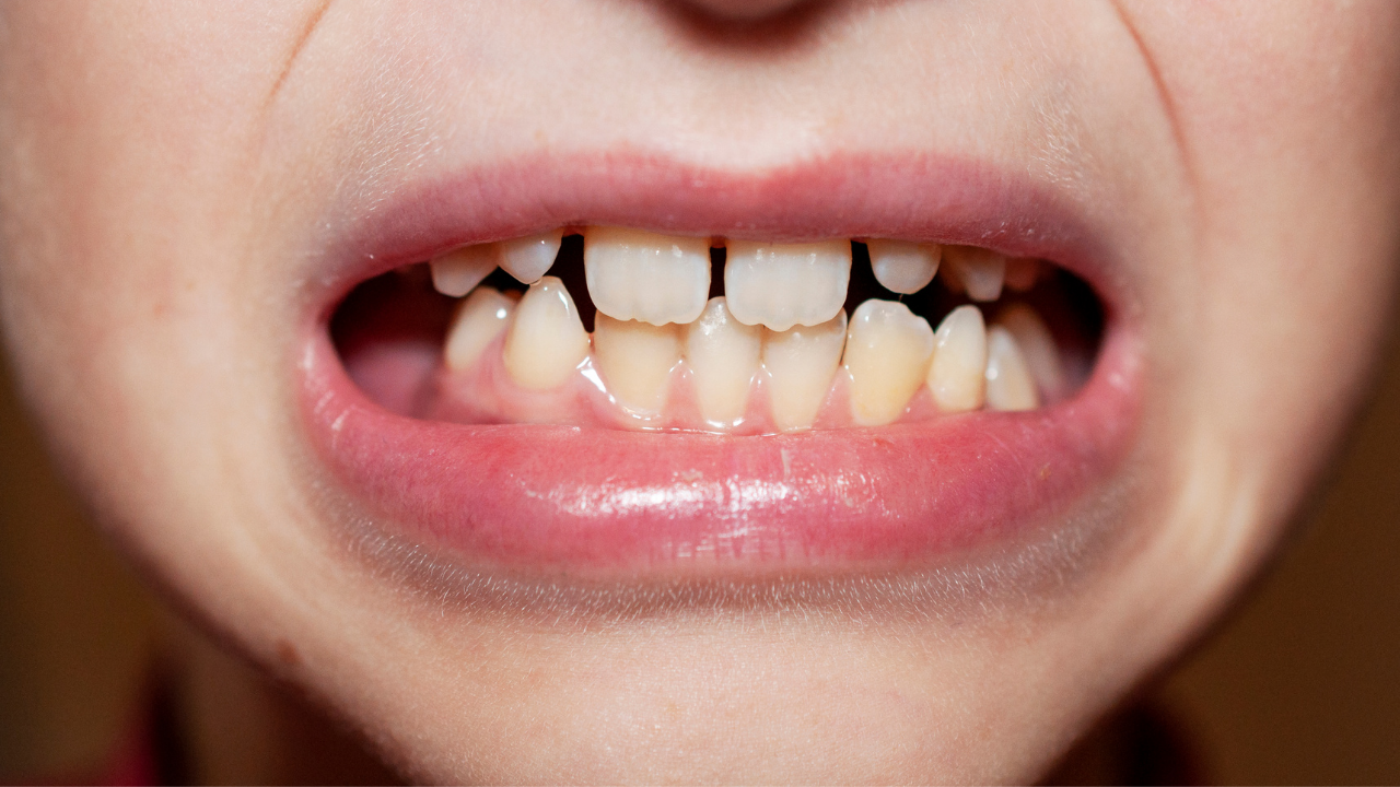 Know These 5 Health Disadvantages of Ignoring Misaligned Teeth