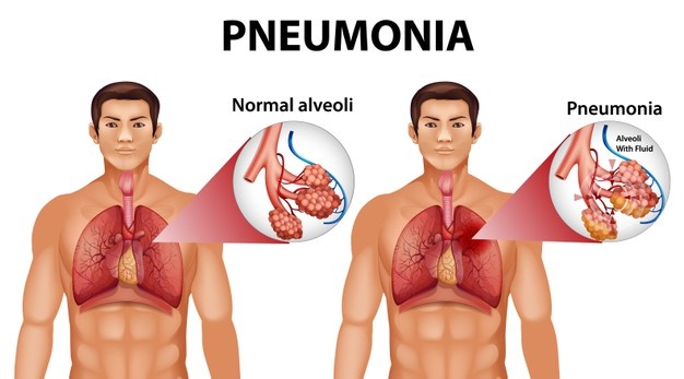 World Pneumonia Day: The Symptoms And Preventive Measures