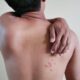 Over 80 pc Indian adults underestimate shingles risk: Report
