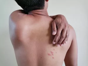 Over 80 pc Indian adults underestimate shingles risk: Report