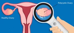 Routine screening key for early detection of ovarian cancer: Experts