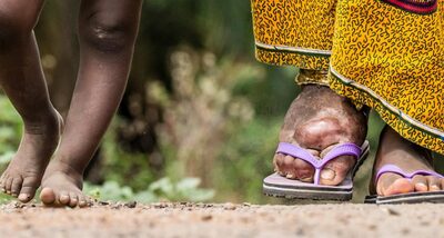UP makes progress in elimination of lymphatic filariasis