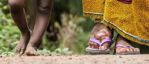 UP makes progress in elimination of lymphatic filariasis