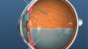Vitrectomy: The surgery to treat retinal damage due to diabetes or digital screens