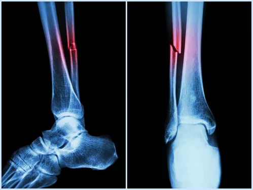 Can AI help patients with bone fractures?