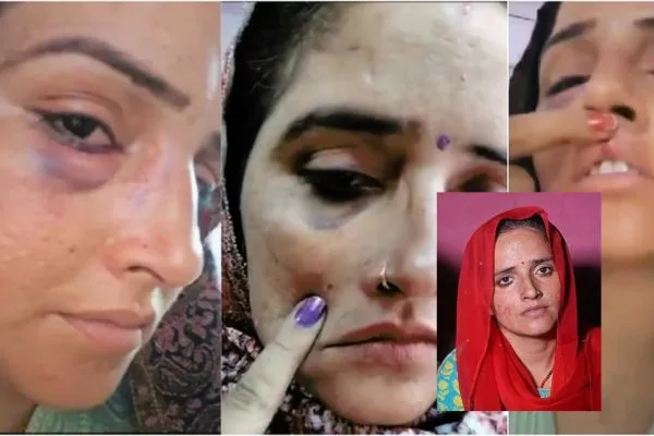 Video of Seema Haider with bruised lip and eye goes viral on the internet 