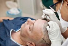Turkey's Hair Transplant Boom: What Makes it the Go-To Destination for Hair Restoration?